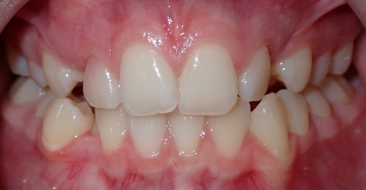 Vivid Smiles patient case 10 before and after treatment comparison before